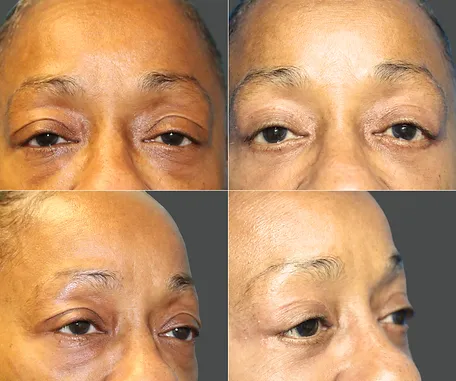 Eyelid Surgery with Rau Plastic Surgery — before & after result