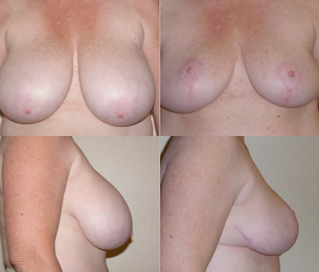 Breast Reduction with Rau Plastic Surgery — before & after result