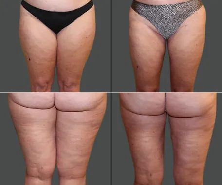 Before & After Gallery — before & after result