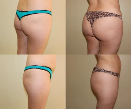 Brazilian Butt Lift with Rau Plastic Surgery — before & after result