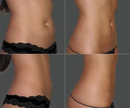 Before & After Gallery — before & after result