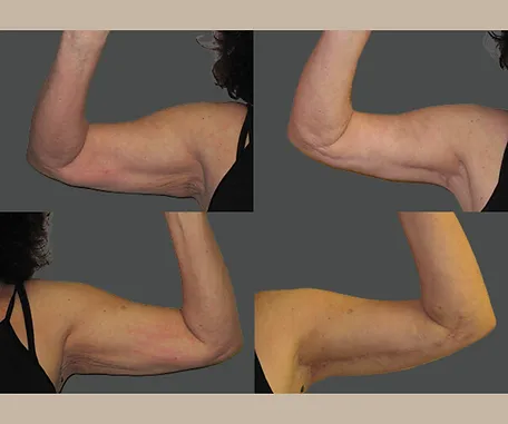 Get More Contoured Arms with Rau Plastic Surgery — before & after result