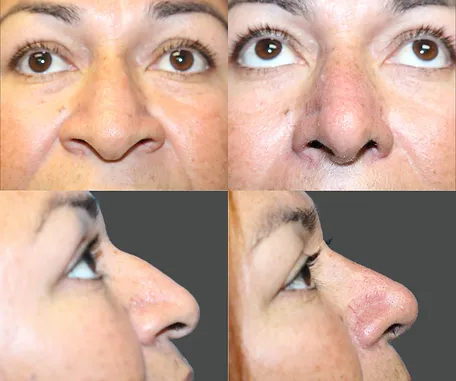 Rhinoplasty with Rau Plastic Surgery — before & after result