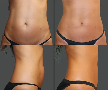 Before & After Gallery — before & after result