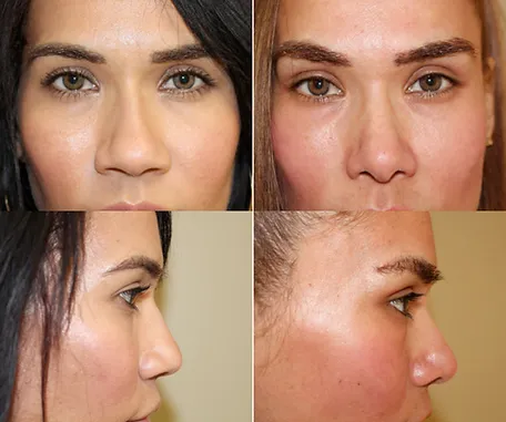 Rhinoplasty with Rau Plastic Surgery — before & after result