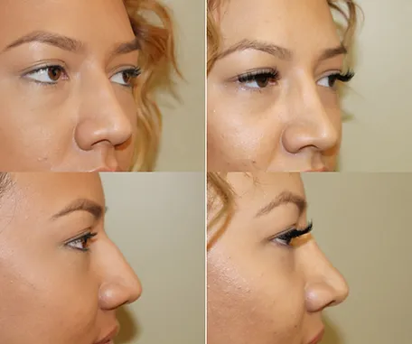 Rhinoplasty with Rau Plastic Surgery — before & after result
