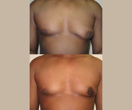 Male Breast Reduction at Rau Plastic Surgery — before & after result