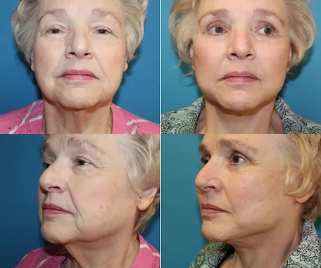 Facelift in Redlands — before & after result