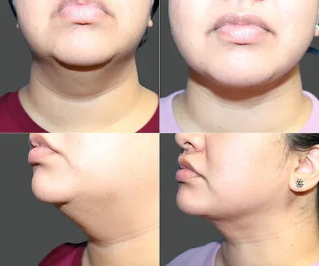 Liposuction of Face and Neck — before & after result