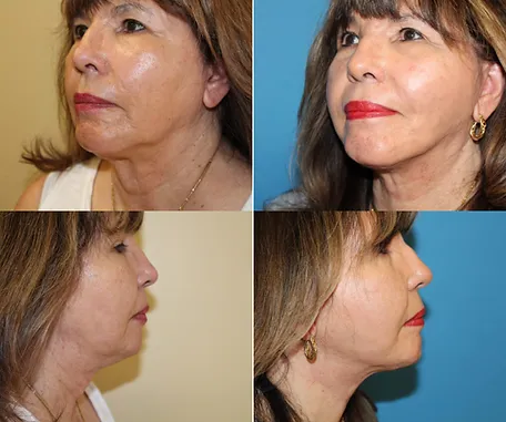 Facelift in Redlands — before & after result