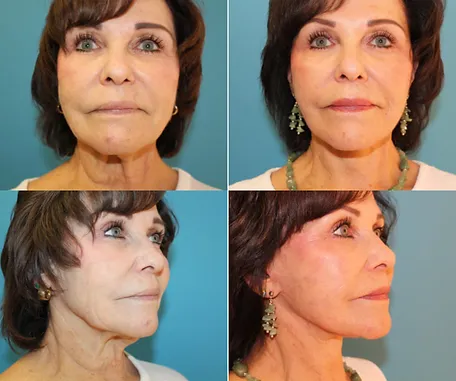 Facelift in Redlands — before & after result