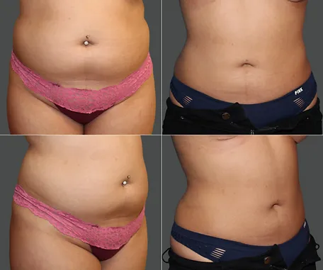 Before & After Gallery — before & after result