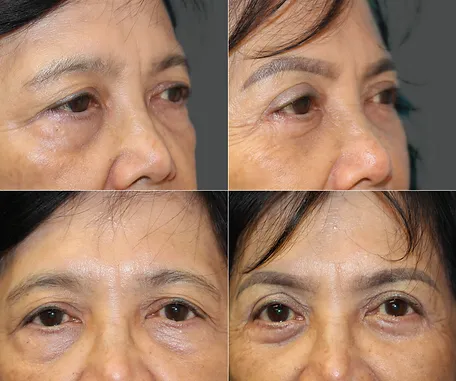 Eyelid Surgery with Rau Plastic Surgery — before & after result