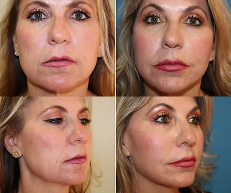 Facelift in Redlands — before & after result