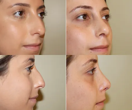 Rhinoplasty with Rau Plastic Surgery — before & after result