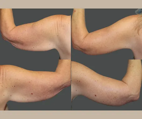 Get More Contoured Arms with Rau Plastic Surgery — before & after result