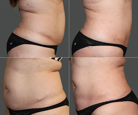 Before & After Gallery — before & after result