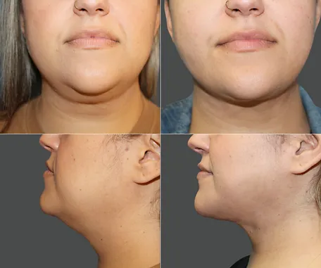 Liposuction of Face and Neck — before & after result
