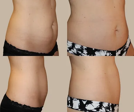 Mini Tummy Tuck with Rau Plastic Surgery — before & after result