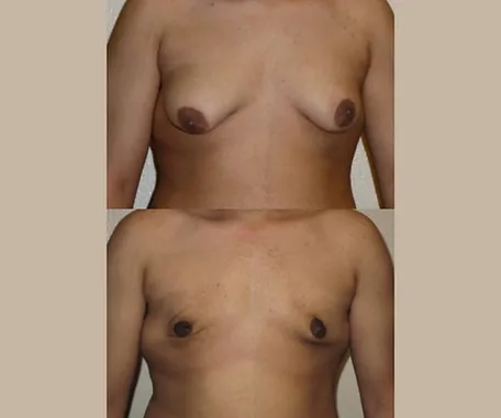 Male Breast Reduction at Rau Plastic Surgery — before & after result