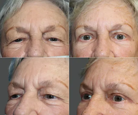 Eyelid Surgery with Rau Plastic Surgery — before & after result