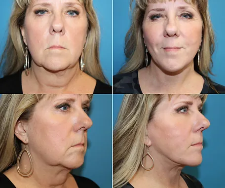 Facelift in Redlands — before & after result