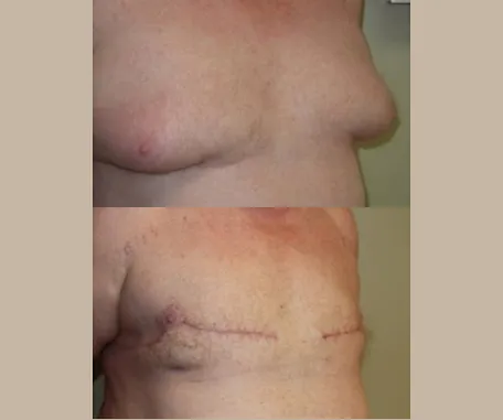 Male Breast Reduction at Rau Plastic Surgery — before & after result