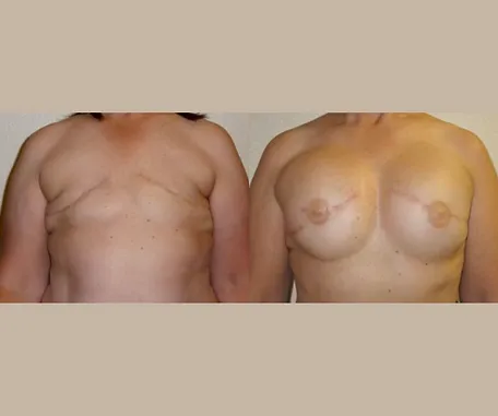 Breast Reconstruction with Rau Plastic Surgery — before & after result