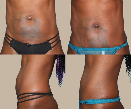 Mini Tummy Tuck with Rau Plastic Surgery — before & after result
