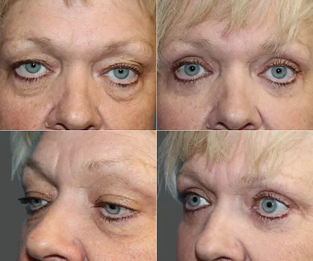 Eyelid Surgery with Rau Plastic Surgery — before & after result
