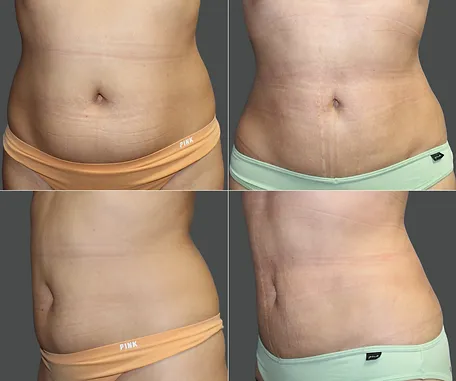 Before & After Gallery — before & after result