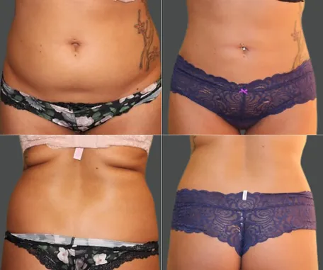 Before & After Gallery — before & after result