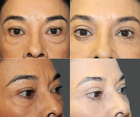 Eyelid Surgery with Rau Plastic Surgery — before & after result