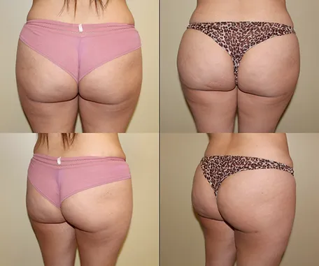 Brazilian Butt Lift with Rau Plastic Surgery — before & after result