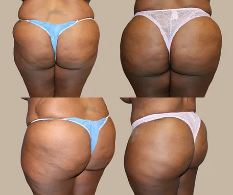 Brazilian Butt Lift with Rau Plastic Surgery — before & after result