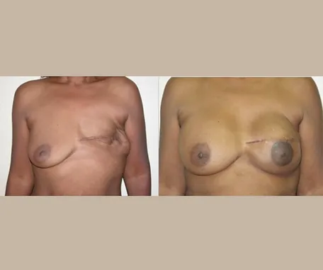 Breast Reconstruction with Rau Plastic Surgery — before & after result