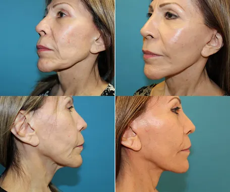 Facelift in Redlands — before & after result