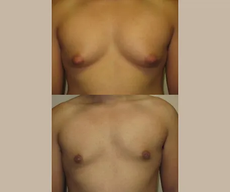 Male Breast Reduction at Rau Plastic Surgery — before & after result