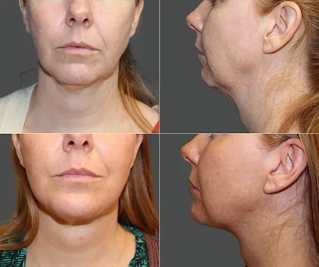 Chin Implant with Rau Plastic Surgery — before & after result