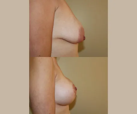 Breast Augmentation + Lift — before & after result