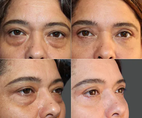 Eyelid Surgery with Rau Plastic Surgery — before & after result