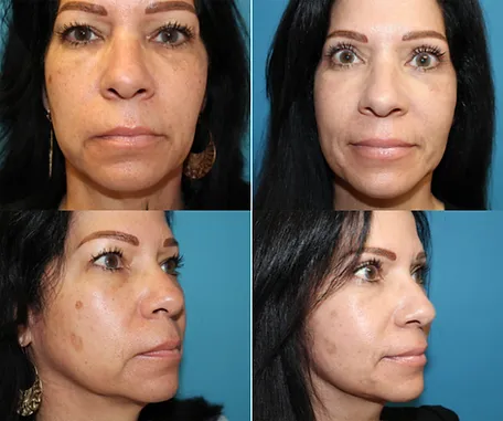 Facelift in Redlands — before & after result