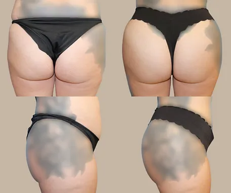 Brazilian Butt Lift with Rau Plastic Surgery — before & after result