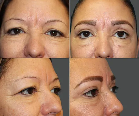 Eyelid Surgery with Rau Plastic Surgery — before & after result