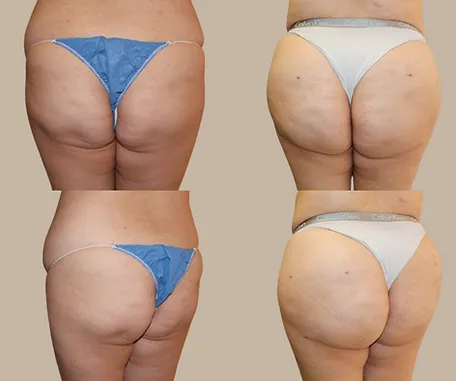 Brazilian Butt Lift with Rau Plastic Surgery — before & after result
