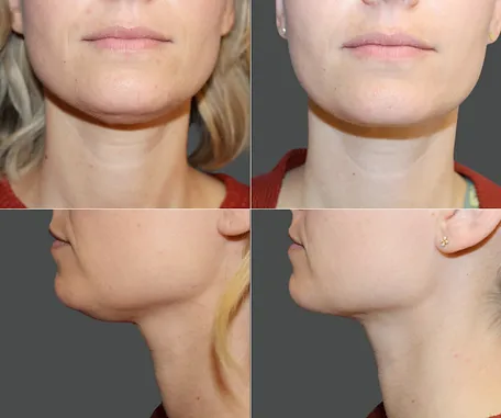 Liposuction of Face and Neck — before & after result