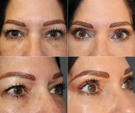 Eyelid Surgery with Rau Plastic Surgery — before & after result