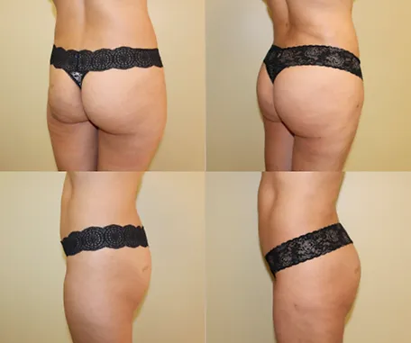 Brazilian Butt Lift with Rau Plastic Surgery — before & after result