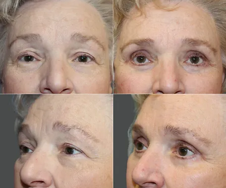 Eyelid Surgery with Rau Plastic Surgery — before & after result