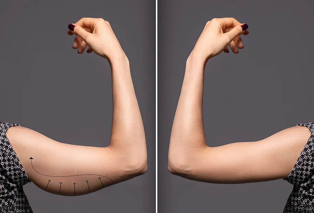 How to Eliminate “Bat Wings” After Weight Loss
